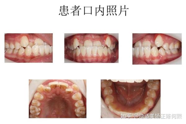 地包天面相揭秘：揭秘男人地包天面相的秘密！