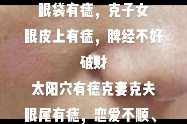 脸上腮痣，财运亨通？一探究竟！