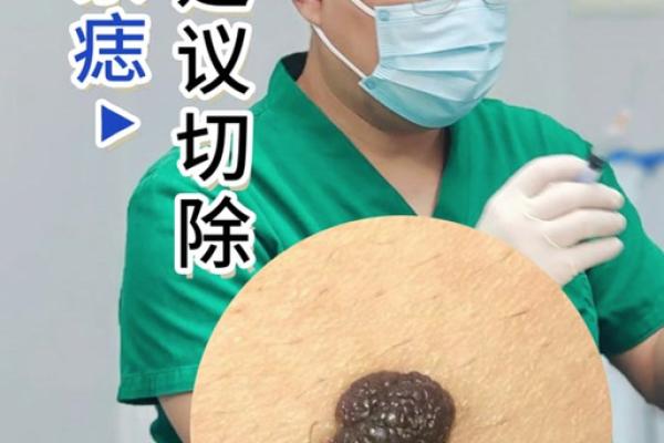 独特大腿外侧痣，是福是祸？一探究竟！