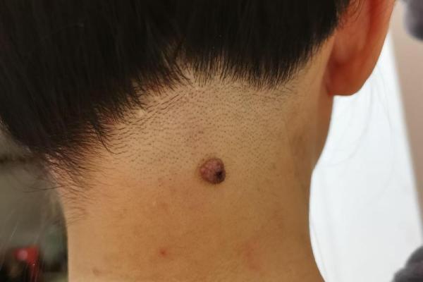 神秘诱惑：揭秘女性颈部痣相的秘密！